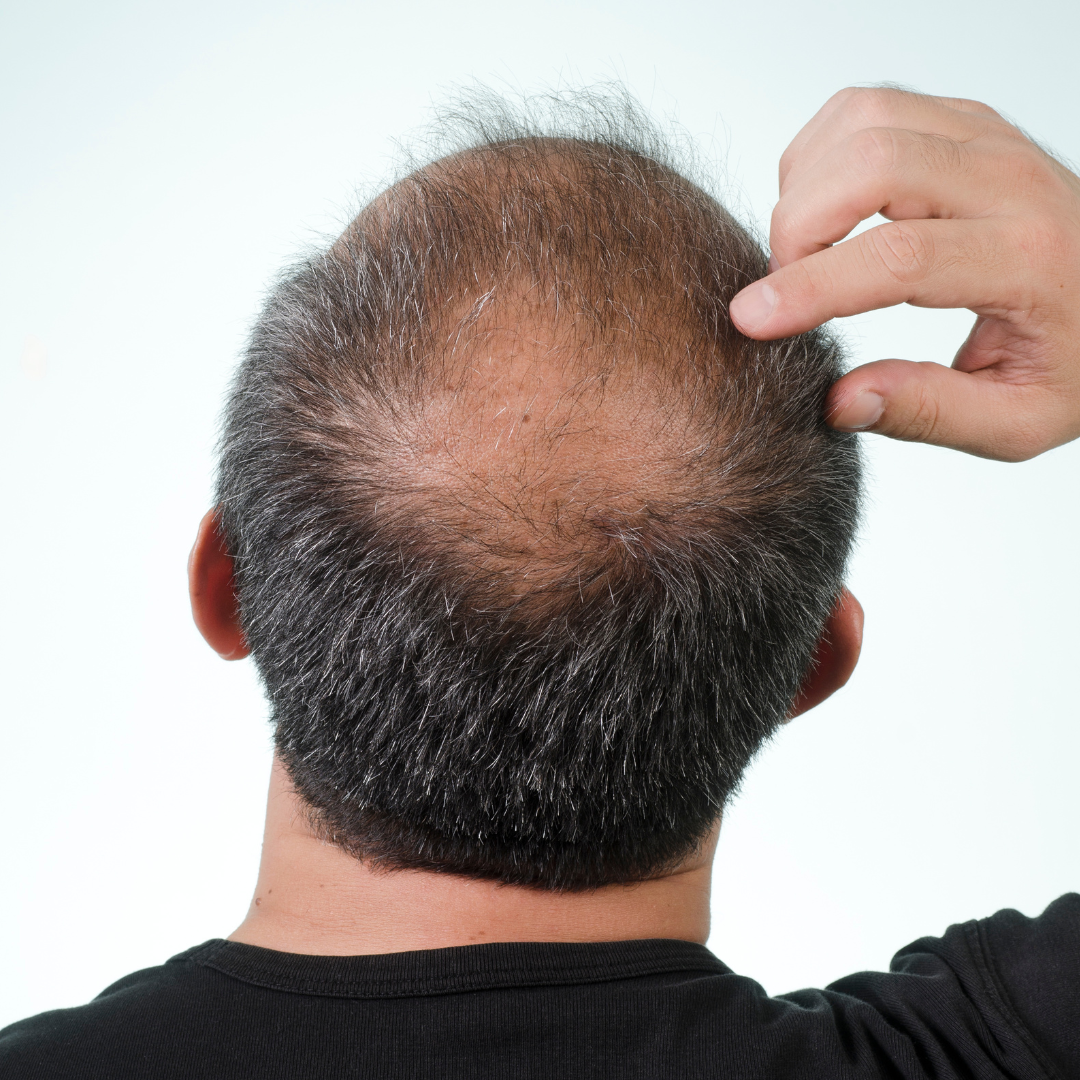 Calvitie chez l'homme : causes et solutions