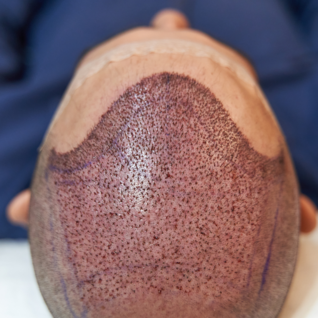 Greffe de cheveux contre la calvitie